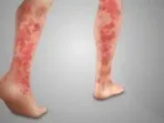 Vasculitis is a dangerous disease of the blood vessels