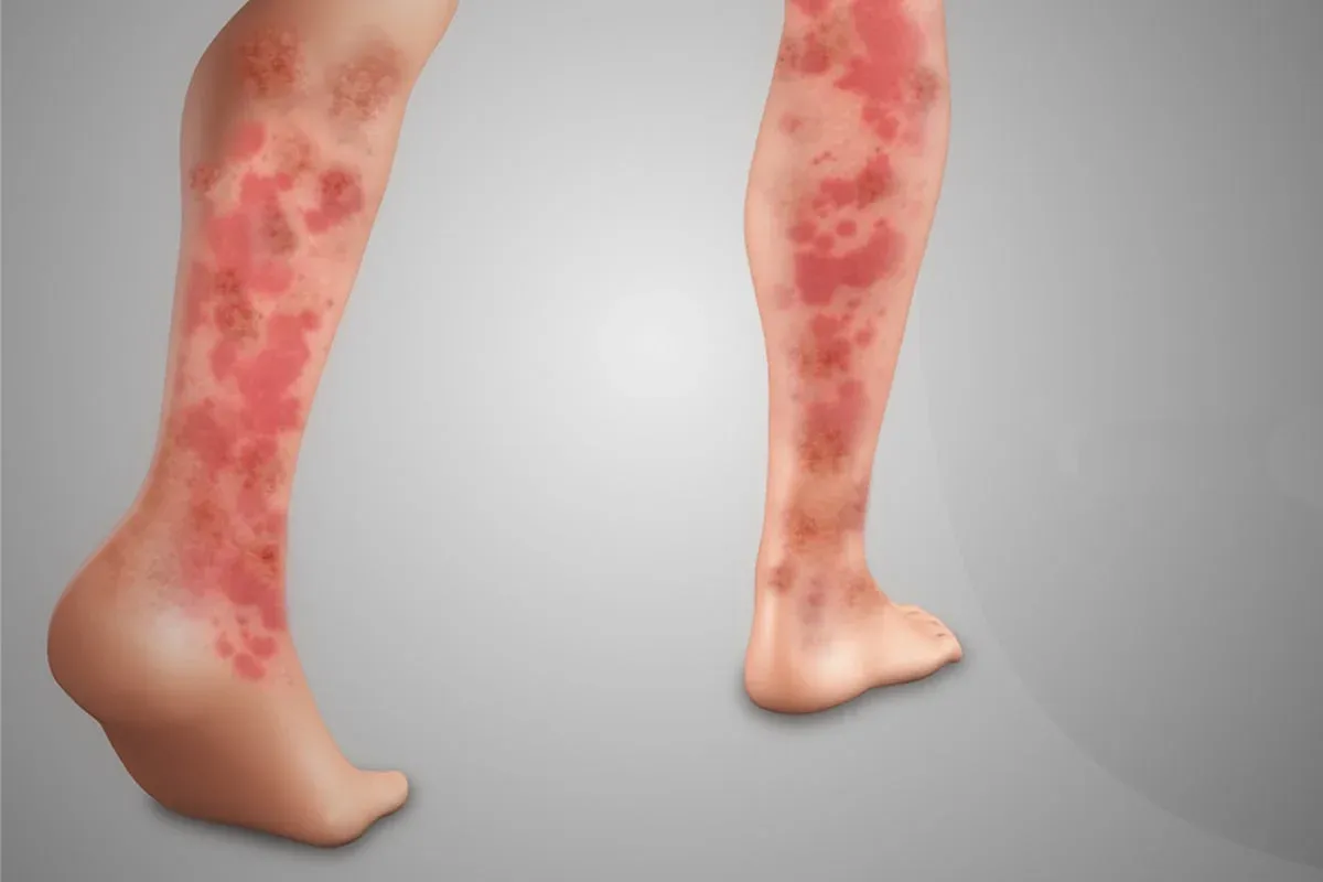 Vasculitis is a dangerous disease of the blood vessels